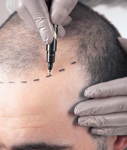 Unshaved Hair Transplantation