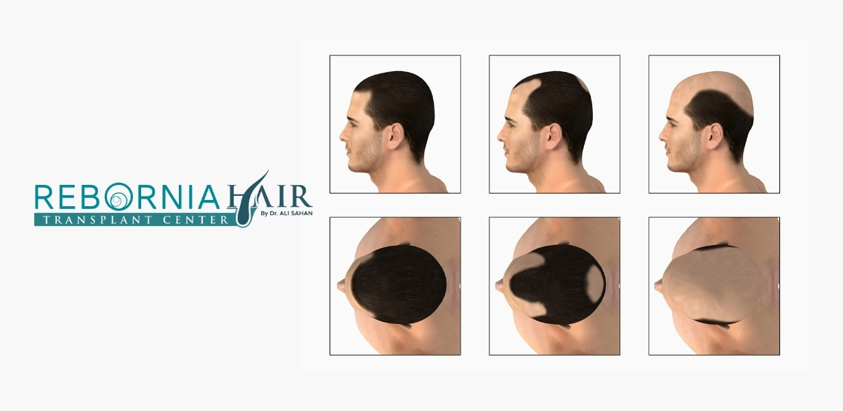 Male Pattern Baldness: Symptoms, Causes & Treatment