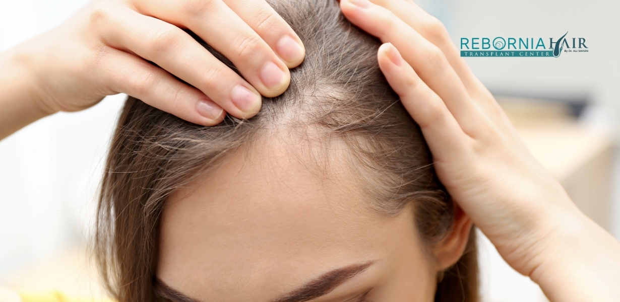 Female Pattern Baldness: Symptoms, Causes & Treatment