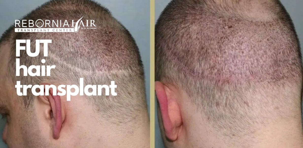 Guide to FUT Hair Transplant: Benefits, Procedure & Recovery