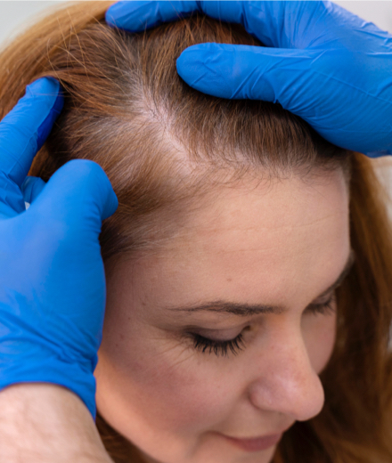 Female Hair Transplantation