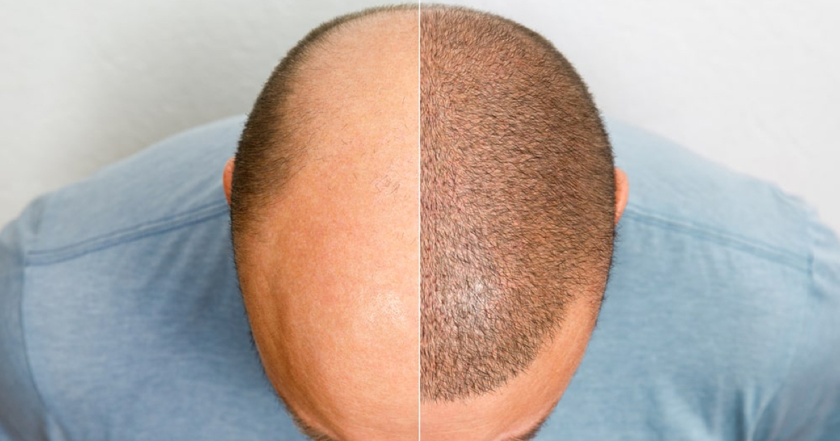 Hair Transplant Costs in USA