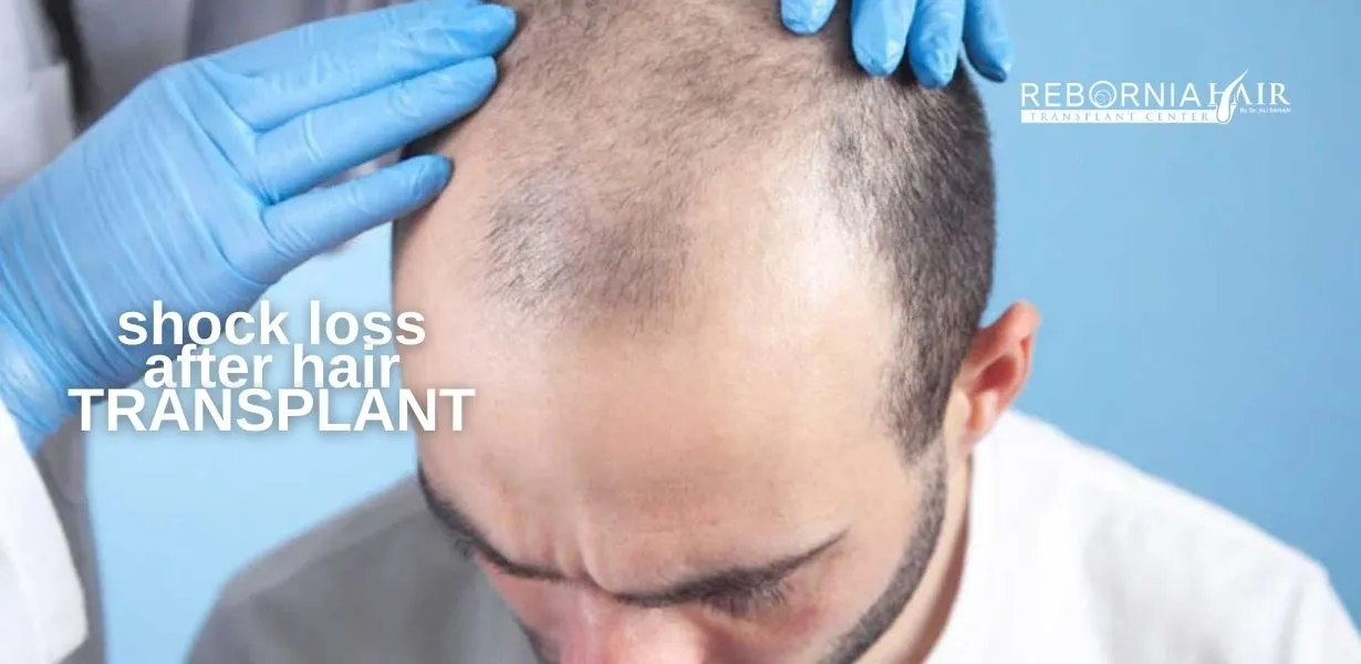 What Is ‘Shock Loss’ After a Hair Transplant?